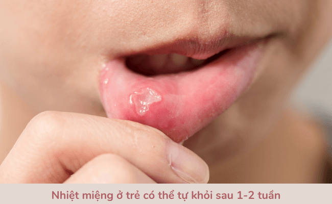 Chữa nhiệt miệng cho bé