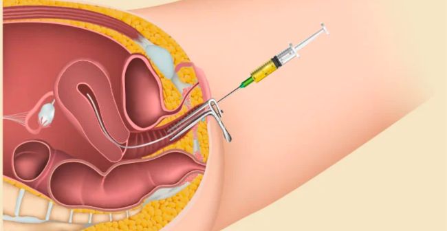 Các phương pháp giúp sinh con theo ý muốn đang được quan tâm hiện nay