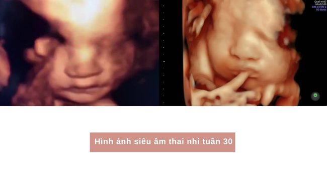 Hình ảnh siêu âm thai nhi tuần 30